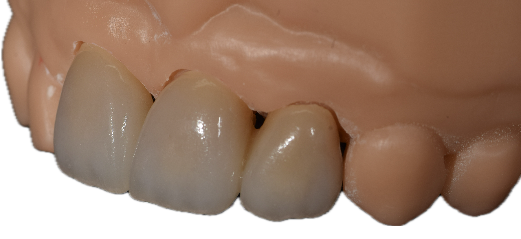 Aesthetic Zirconia 3