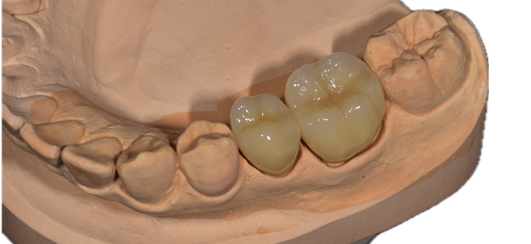 Aesthetic Zirconia 6