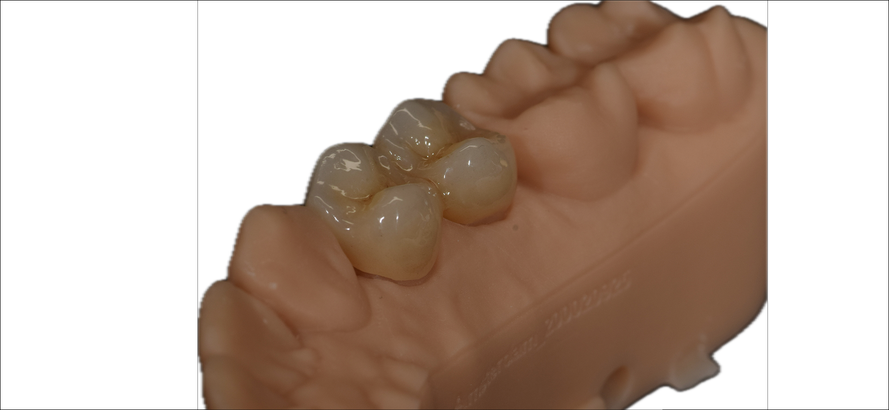 Anatomic Zirconia 10